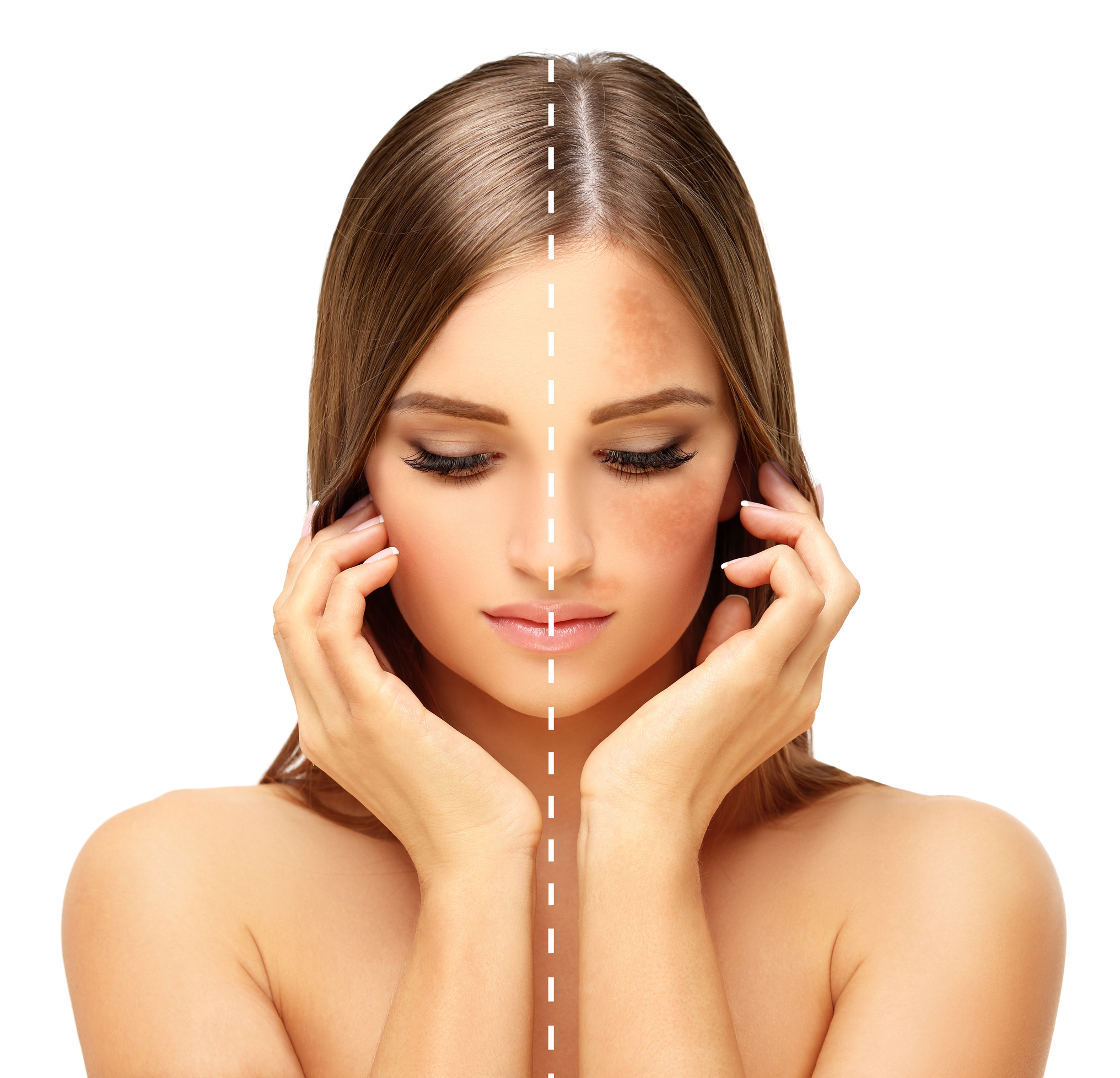 Freckles,dark spots,hyperpigmentation(melasma or chloasma)